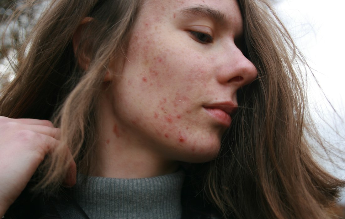 The same product can suit one person’s skin and not another’s